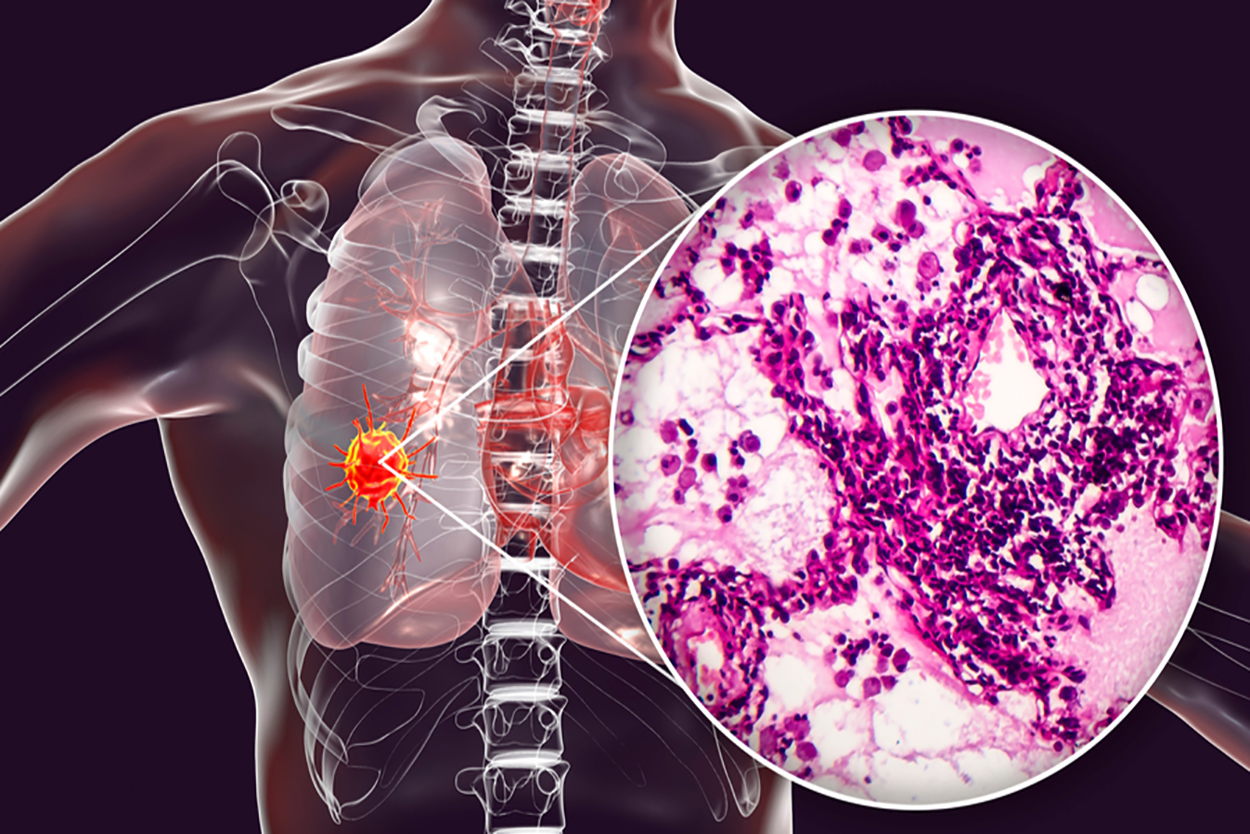 Adjuvant Osimertinib Effective In Early Stage Egfr-mutated Nsclc - Ace 