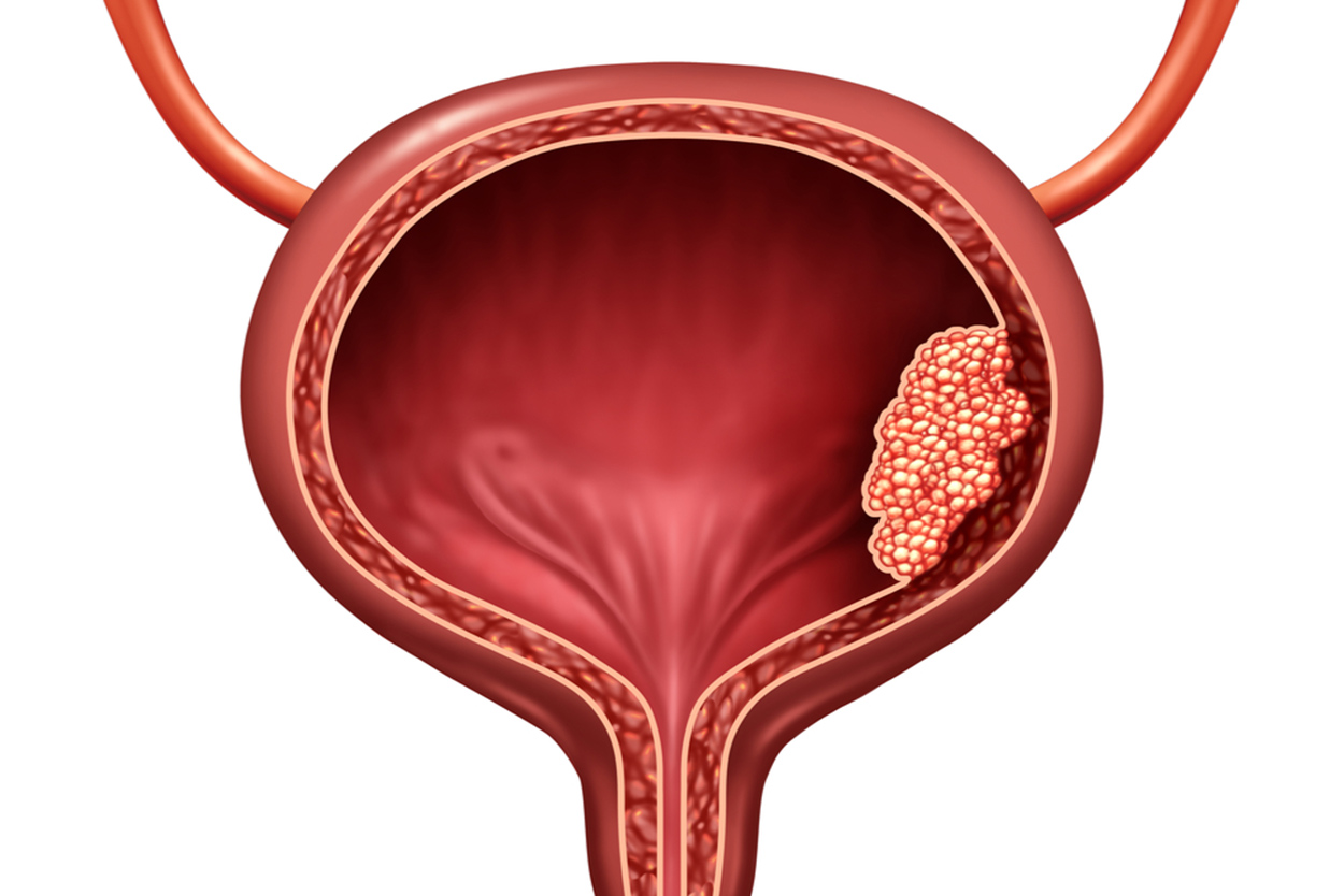 Intravesical Gene Therapy for NonMuscle Invasive Bladder