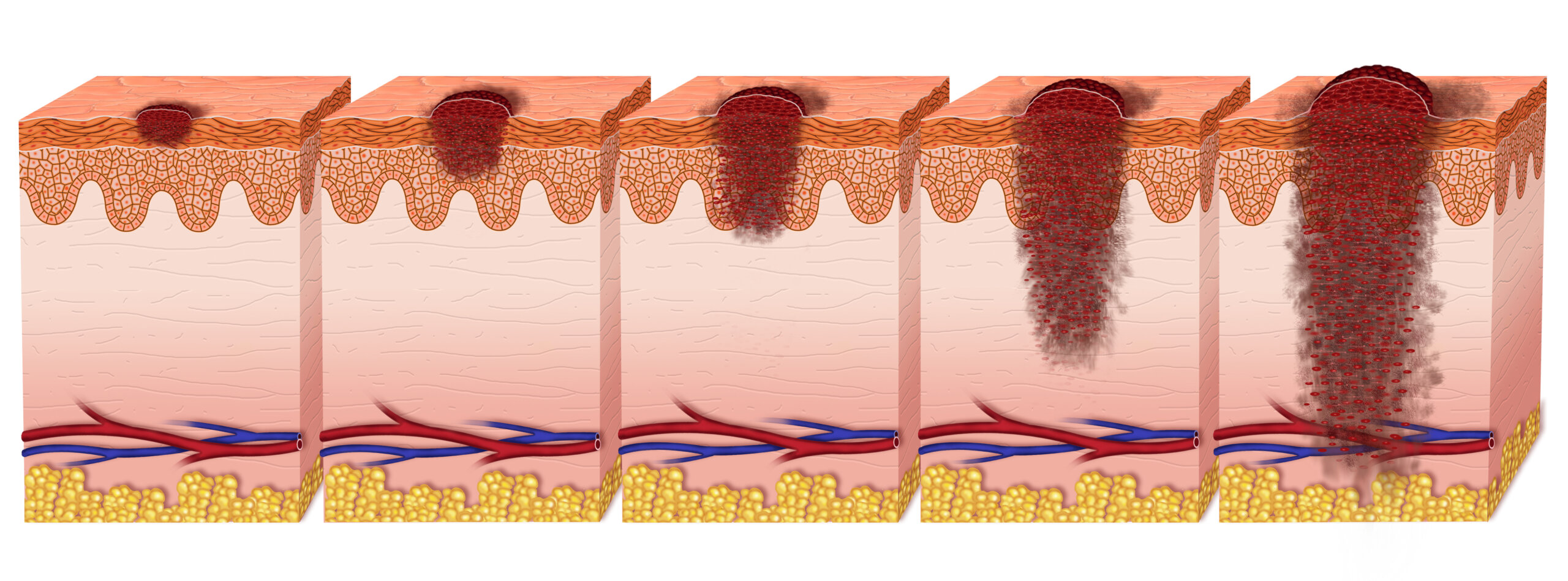 Is There A Stage 5 Melanoma